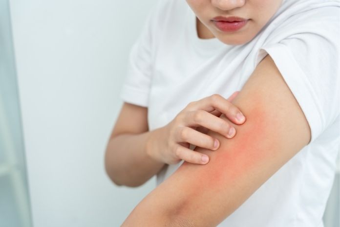 Can Hay Fever Cause a Rash