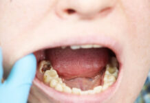 Cavities Explained: Causes, Stages, Symptoms, and Treatment Options Cavities Explained Causes Stages Symptoms