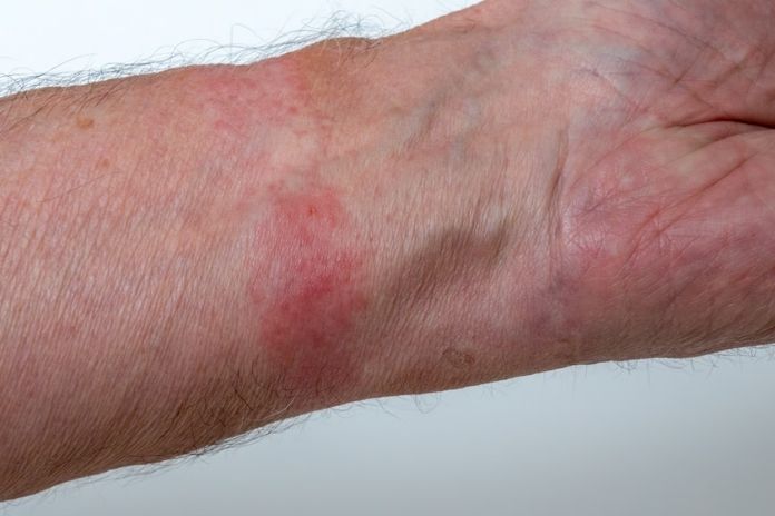 Dermatomyositis