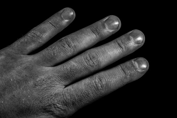 Digital Clubbing and Hypertrophic Pulmonary Osteoarthropathy