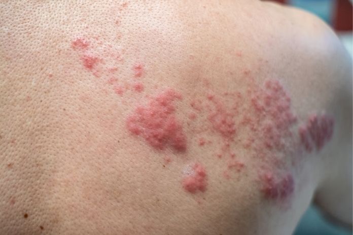 Erythema Gyratum Repens