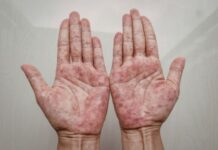 From Coal Tar to Biologics: Finding the Right Severity-Based Treatment for Your Plaque Psoriasis From Coal Tar to Biologics