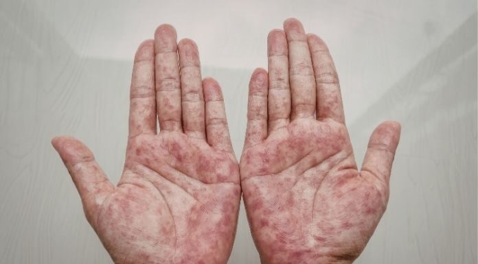 From Coal Tar to Biologics: Finding the Right Severity-Based Treatment for Your Plaque Psoriasis From Coal Tar to Biologics