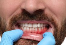 Gum Recession: Causes, Symptoms, Treatment, and Can It Be Reversed? Gum Recession