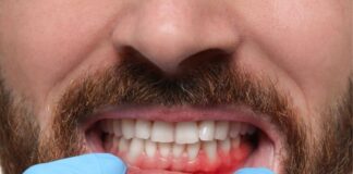 Gum Recession: Causes, Symptoms, Treatment, and Can It Be Reversed? Gum Recession