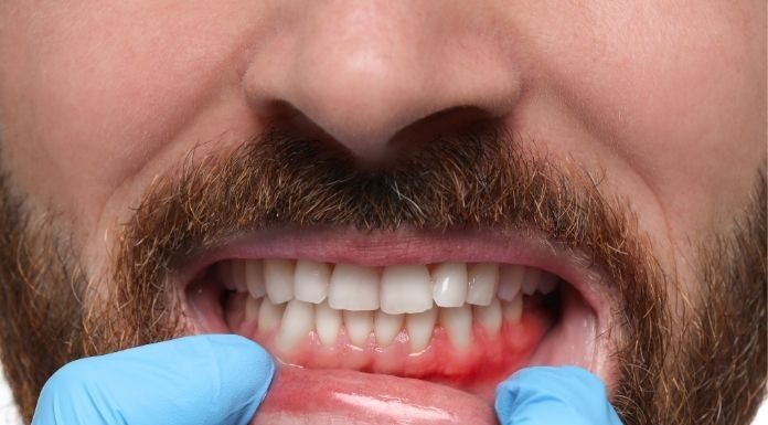 Gum Recession: Causes, Symptoms, Treatment, and Can It Be Reversed? Gum Recession