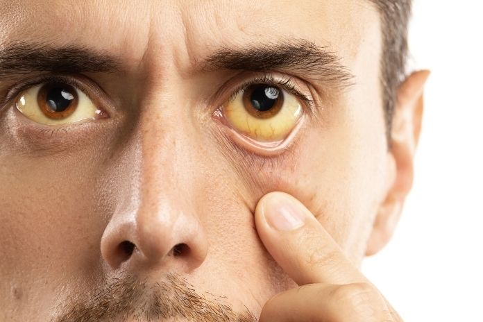 Hay Fever Eye Symptoms vs Other Eye Conditions