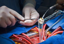 Heart Valve Replacement: Traditional Surgery vs. TAVR Heart Valve Replacement Traditional Surgery vs TAVR