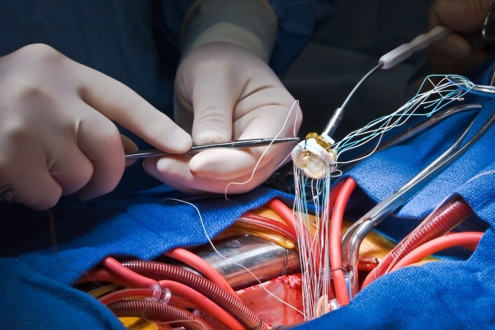 Heart Valve Replacement Traditional Surgery vs TAVR Heart Valve Replacement Traditional Surgery vs TAVR