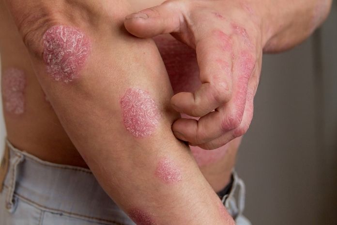 How Doctors Determine Psoriasis Severity