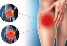 How Long Does Inflammation Last After an Injury? How Long Does Inflammation Last After an Injury