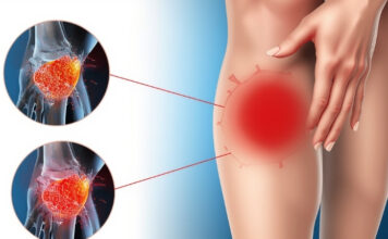 How Long Does Inflammation Last After an Injury? How Long Does Inflammation Last After an Injury