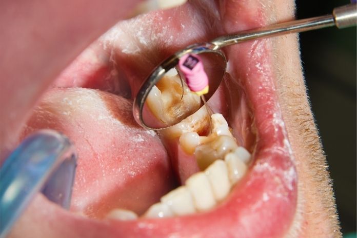 How Long Does a Root Canal Take