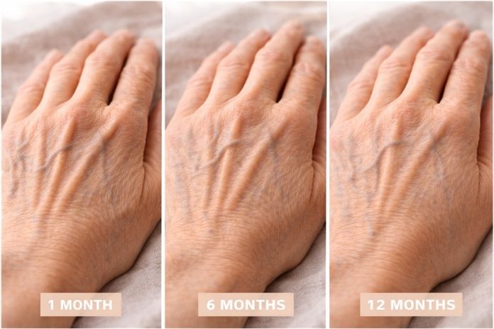 How Skin May Change After Weight Loss