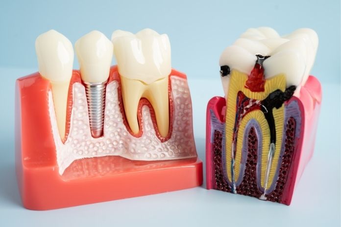 How to Reduce the Risk of Needing a Root Canal