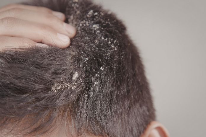 Moderate Psoriasis