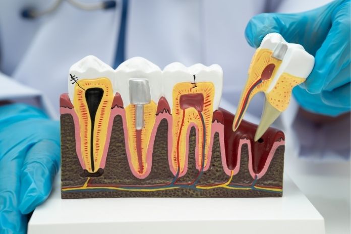 Root Canal vs Tooth Extraction_ Which Is Better