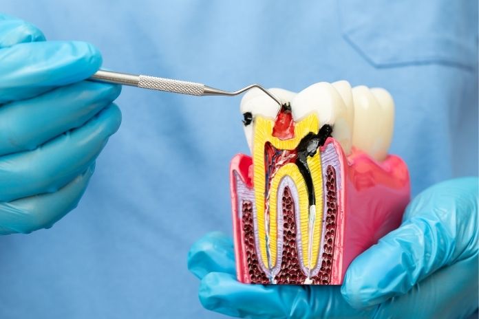 Signs You May Need a Root Canal