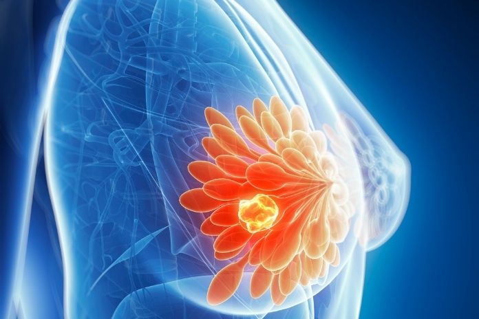 Stage 1 Breast Cancer
