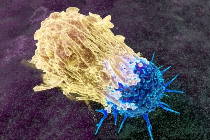 Stage 3 Breast Cancer