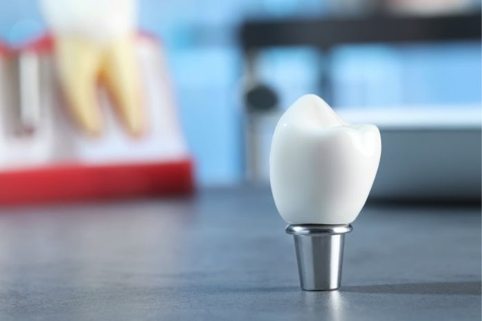 The Core Difference Between Dental Veneers and Crowns