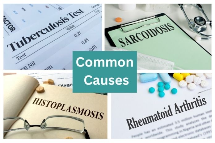 The Most Common Causes of Multiple Lung Nodules