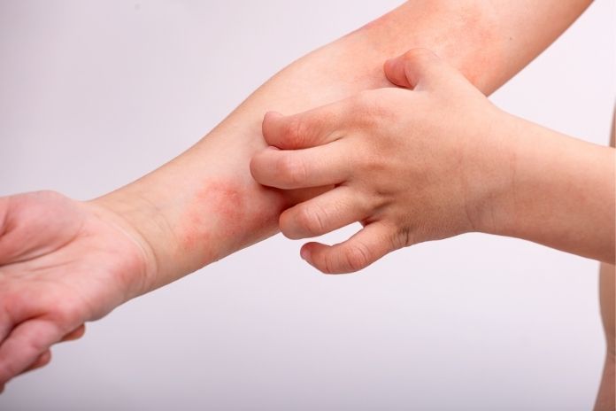 Types of Skin Reactions Linked to Hay Fever
