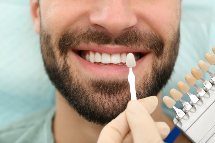 Veneers vs Crowns Whats the Difference and Which Do You Need Veneers vs Crowns Whats the Difference and Which Do You Need