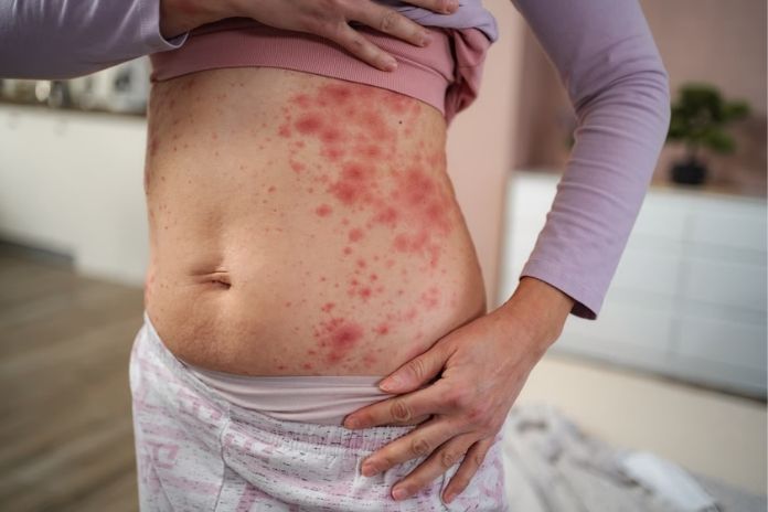 What Breakthrough Measles Looks Like Compared to Unvaccinated Measles