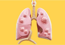 What Causes Multiple Nodules in the Lungs? A Doctor-Reviewed Guide What Causes Multiple Nodules in the Lungs