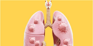 What Causes Multiple Nodules in the Lungs? A Doctor-Reviewed Guide What Causes Multiple Nodules in the Lungs