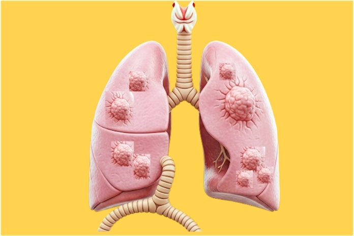 What Causes Multiple Nodules in the Lungs What Causes Multiple Nodules in the Lungs