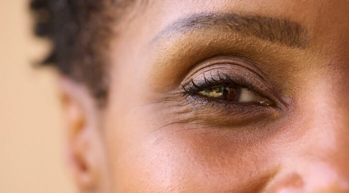 What Deficiency Causes Dark Circles Under the Eyes? What Deficiency Causes Dark Circles Under the Eyes?