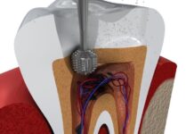 What Is a Root Canal? What to Expect and Does It Really Hurt? What Is a Root Canal