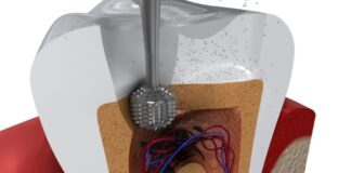 What Is a Root Canal? What to Expect and Does It Really Hurt? What Is a Root Canal