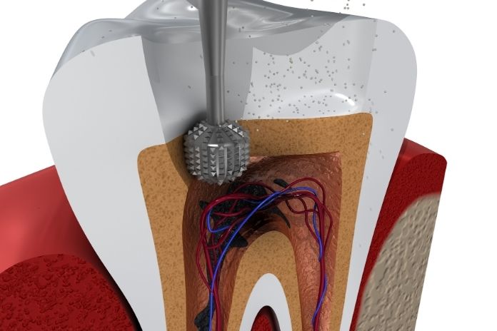 What Is a Root Canal What Is a Root Canal