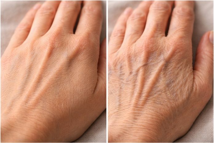 What People Mean by Ozempic Hand