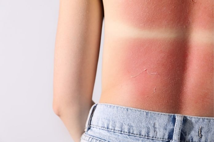 What Your Skin Tries to Do After UV Exposure