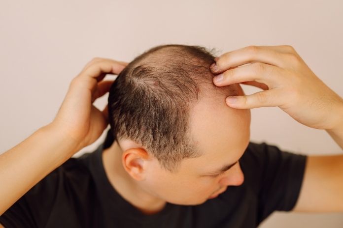 Which Types of Hair Loss Might Respond Best