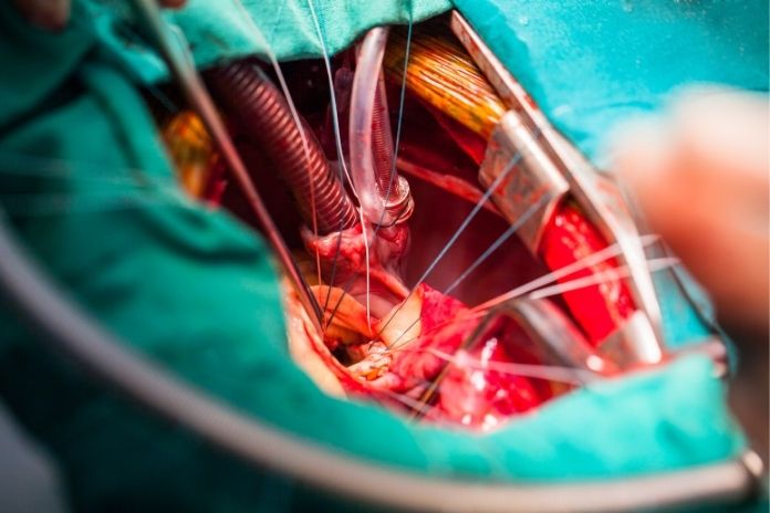 Who May Benefit Most From TAVR
