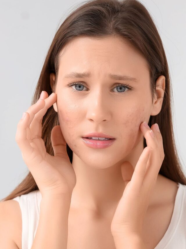 Hormonal Acne After 25