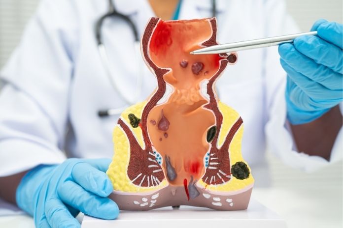 Can Hemorrhoids Be Prevented