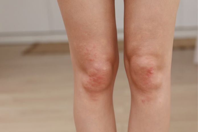 Erythema Nodosum