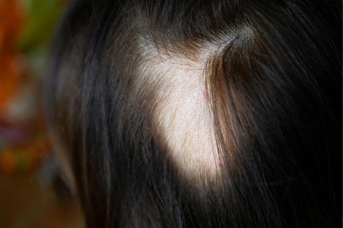 Hair Loss When Follicles Are Permanently or Progressively Affected