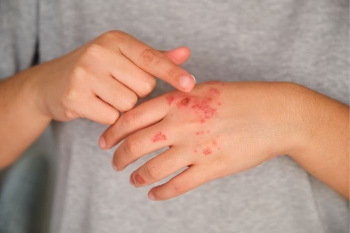 Indirect Life-Threatening Risks Of Hidradenitis Suppurativa