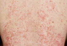Indolent Systemic Mastocytosis Explained: Signs, Triggers, and Management Indolent Systemic Mastocytosis Explained