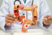 Iron Deficiency Anemia and Colorectal Cancer: What Women Should Know Iron Deficiency Anemia and Colorectal Cancer