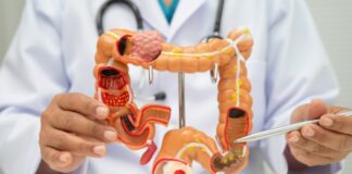 Iron Deficiency Anemia and Colorectal Cancer: What Women Should Know Iron Deficiency Anemia and Colorectal Cancer