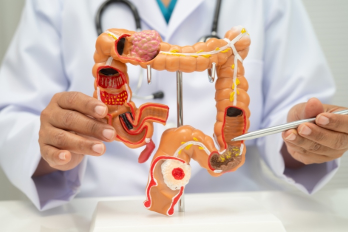 Iron Deficiency Anemia and Colorectal Cancer Iron Deficiency Anemia and Colorectal Cancer