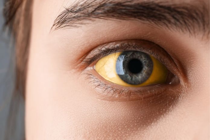 Jaundice Yellowing of Skin and Whites of Eyes